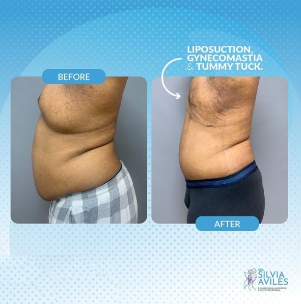 Before and After Lipo 360 and Tummy Tuck in the Dominican Republic
